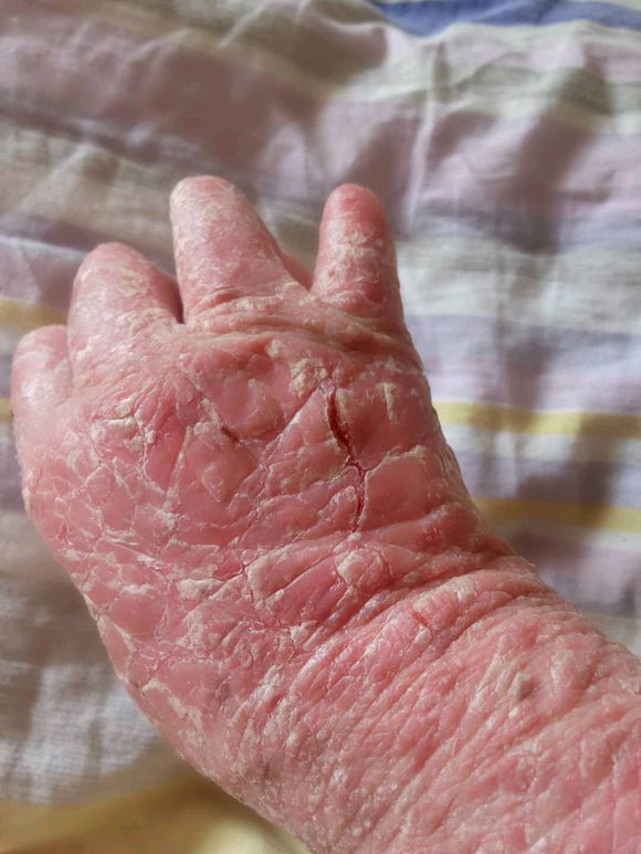 牛皮癣容易在身体的哪些部位发生