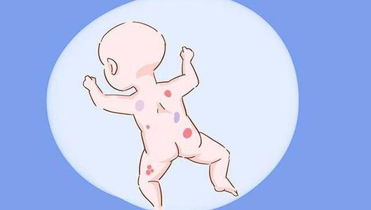 得了牛皮癣之后常见的症状有哪些