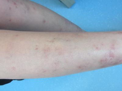 广州医院治疗牛皮癣注意事项有哪些