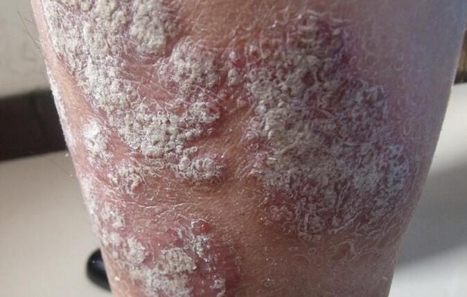 银屑病患者可以多吃哪些食物来延缓皮肤衰老呢