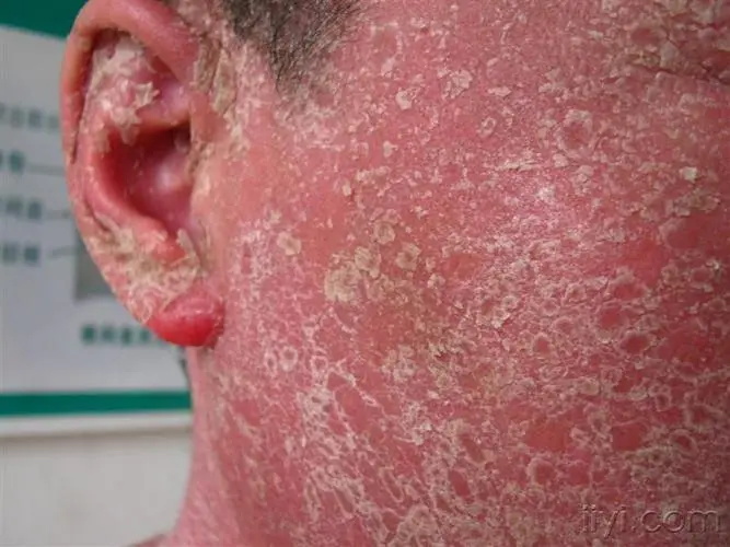 儿童牛皮癣早期症状有哪些