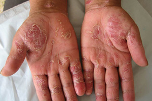 得了牛皮癣之后会传染人吗