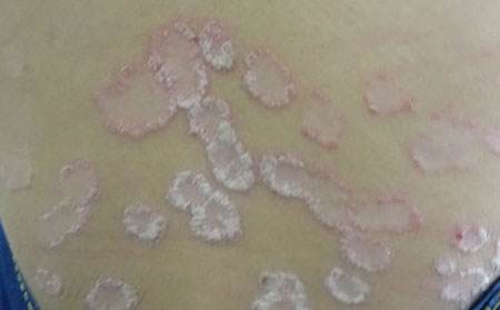 得牛皮癣疾病会传染给我老婆吗