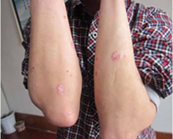 关节病型银屑病长什么样呢