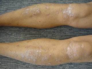 患有牛皮癣这个疾病时患者们需要注意的有什么