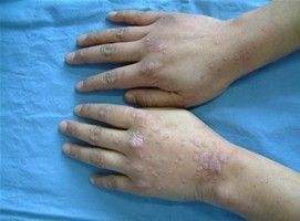 初期治疗牛皮癣有哪些可行的方案