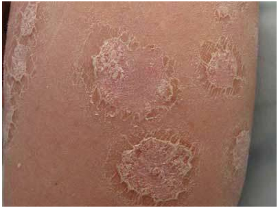 牛皮癣突然急性发作广州医生教你如何正确应对