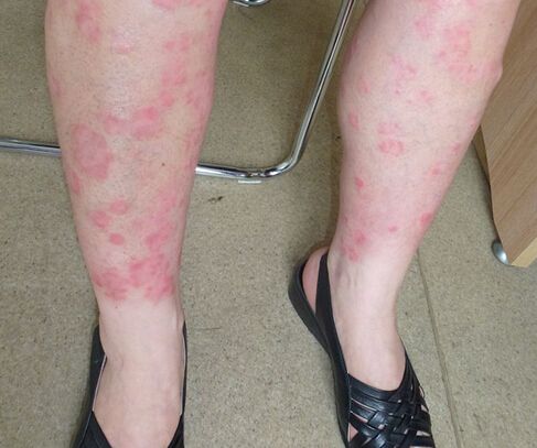 银屑病治疗中的坏习惯你是否有