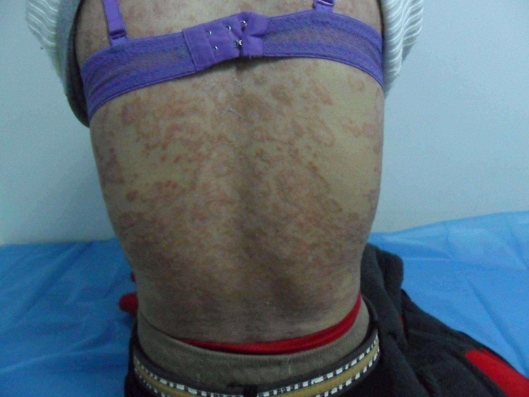 不要因为自己的无知耽误牛皮癣的治疗