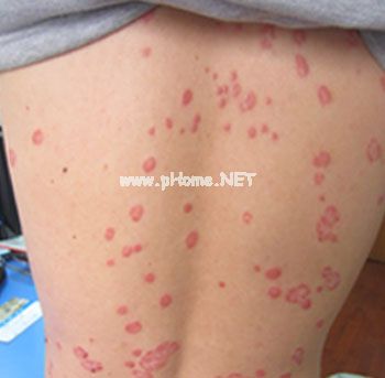 得了牛皮癣能不能喝牛奶吗