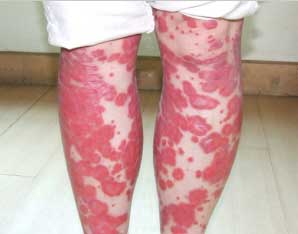 适合红皮病型银屑病患者的饮食有什么