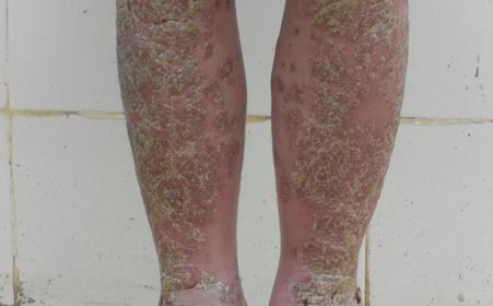 要怎么看有没有患上牛皮癣呢