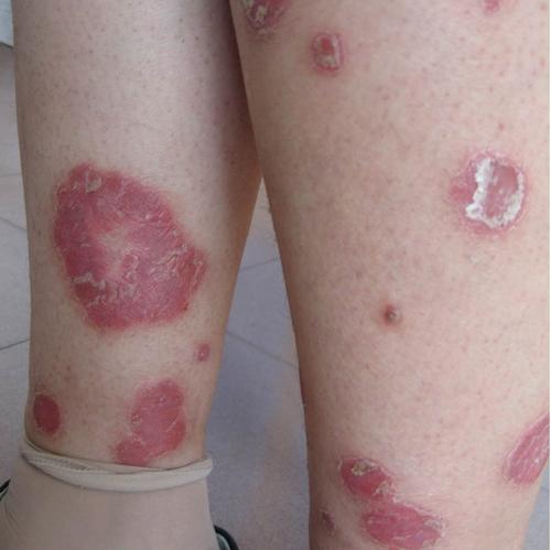 在医院检查银屑病时要注意什么