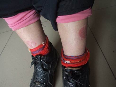 患上牛皮癣饮食要怎么改善呢