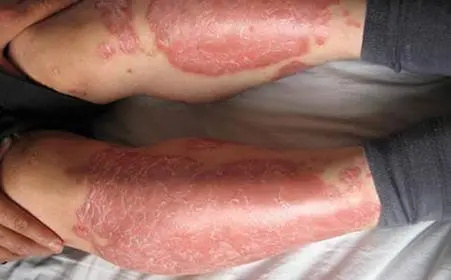 引起牛皮癣反复发作的因素是什么