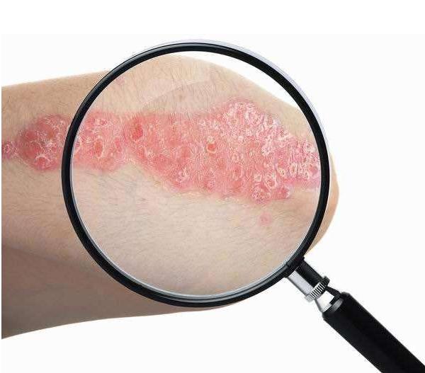 牛皮癣患者为什么不可以化浓妆