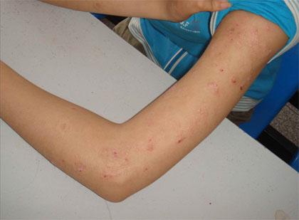 在广州使用什么方法治疗牛皮癣比较好