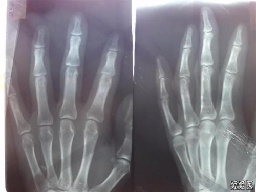 广州新世纪:关节型牛皮癣需要注意的事情有很多