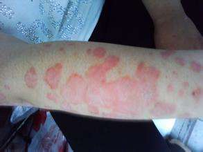 患上牛皮癣这个疾病的治疗方法会有哪些呢