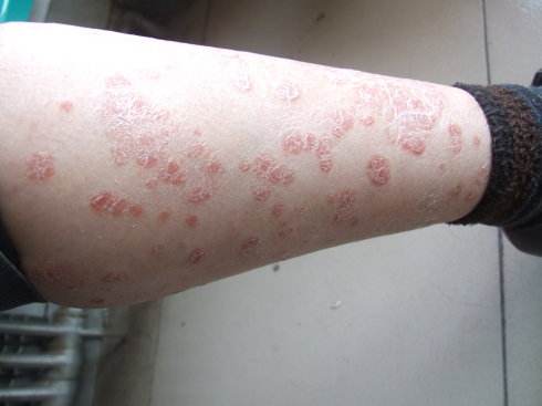 患上这个牛皮癣的话应该要怎么进行治疗呢