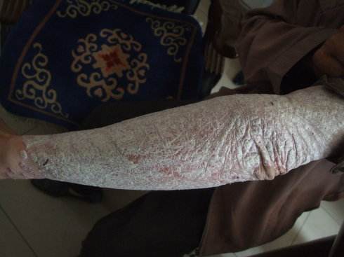 患牛皮癣后患者们能吃什么补充呢