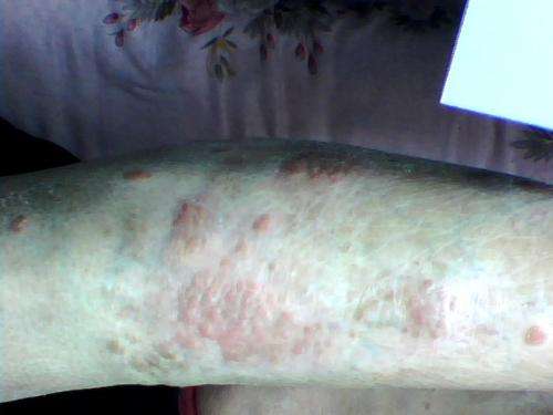 夏季想靠运动促进牛皮癣康复你还需要知道什么