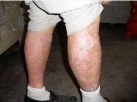 患有牛皮癣患者们是可以吃哪些食物呢