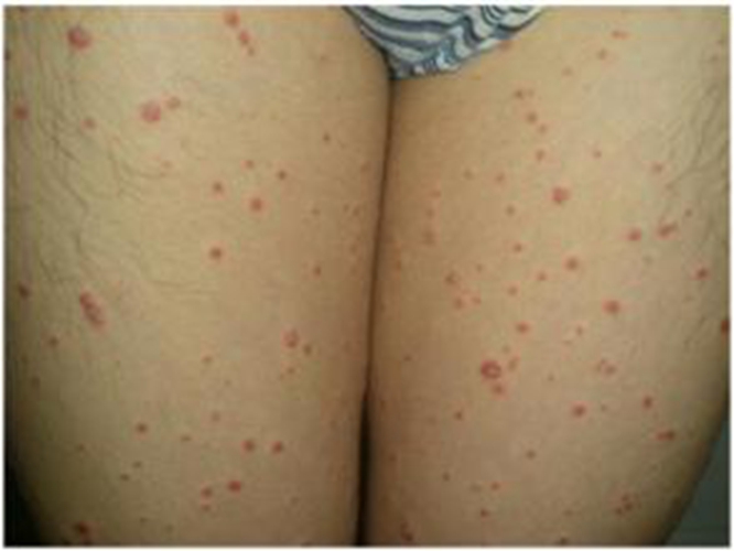 孕妇得了牛皮癣应该要怎么去治疗呢