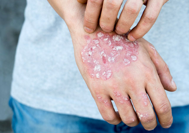 儿童牛皮癣应该如何护理呢