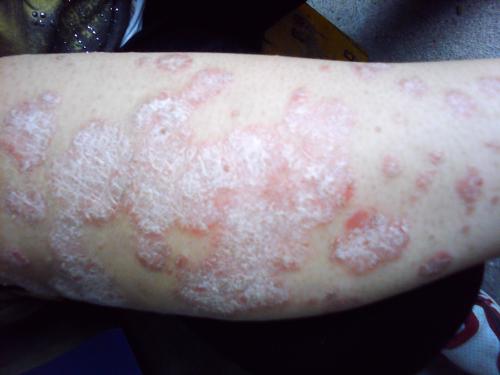 小心这种牛皮鲜青少年都容易中招