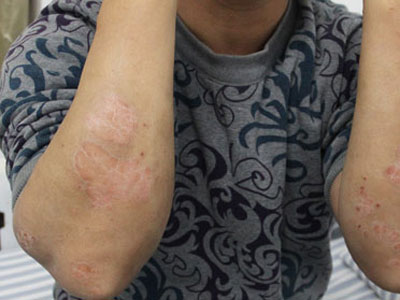 得了牛皮癣坚持治疗病情却不见好的原因是什么