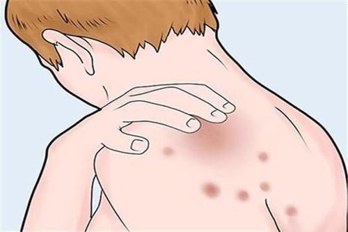 广州专家:得了顽固的银屑病之后还能治好吗