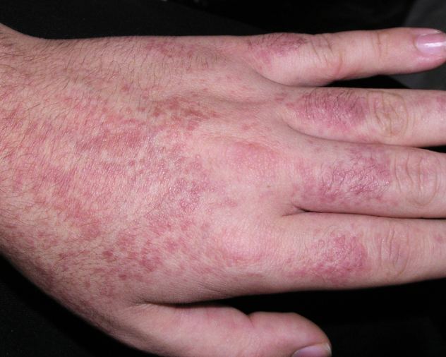 为啥得牛皮癣的人越来越多