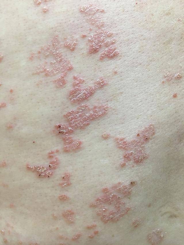 牛皮癣和经常抽烟是否有关系呢