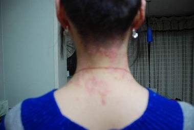 患上牛皮癣的话患者们应该要怎么护理呢