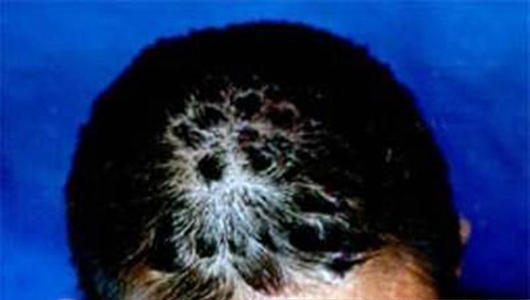 牛皮癣康复后为啥还需要抗复发治疗