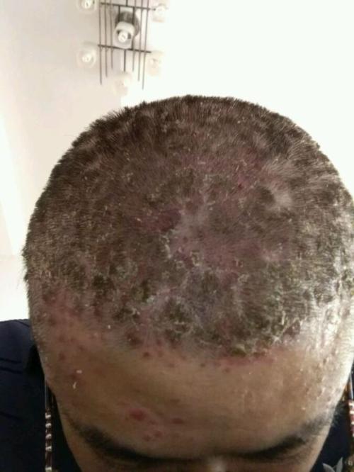 头上长了牛皮癣会有什么症状