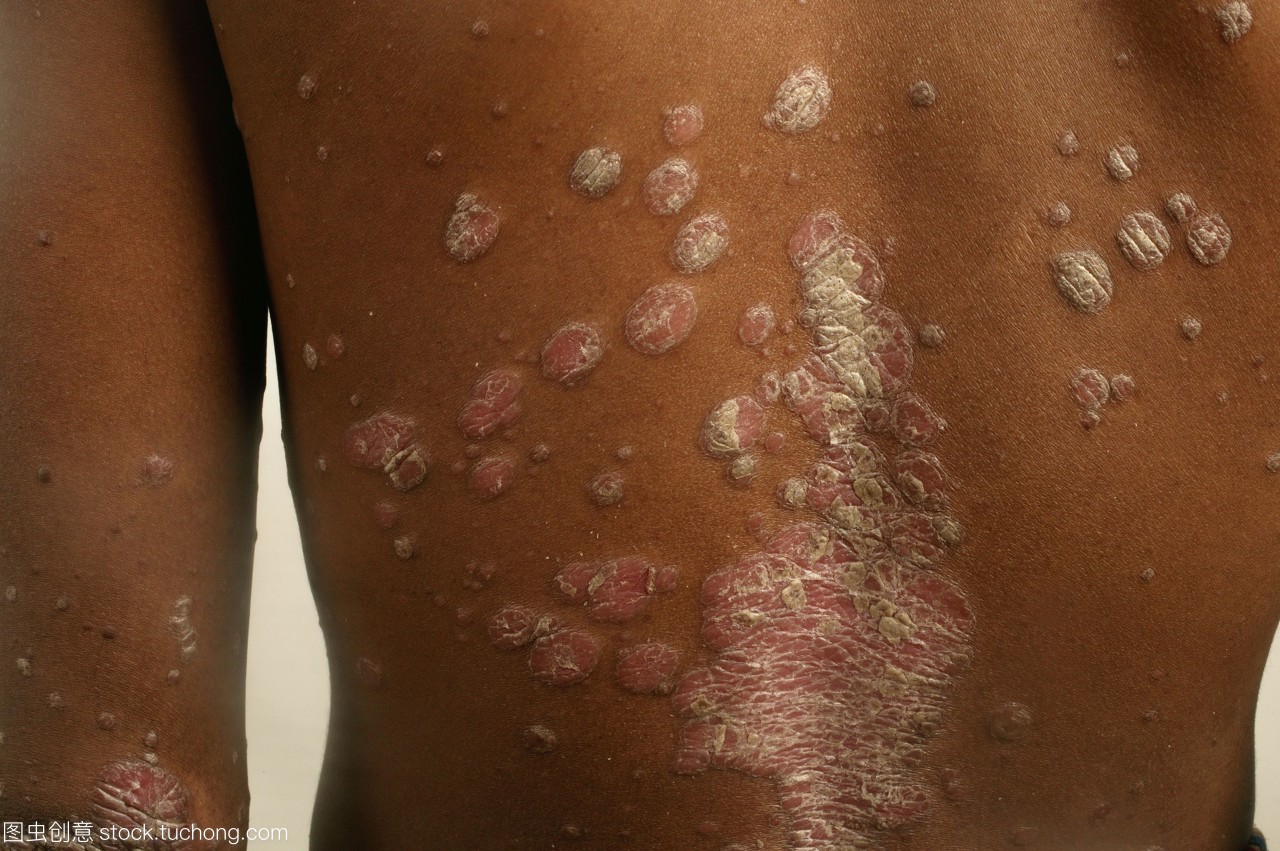 广州牛皮癣复发不医治会有什么样的影响