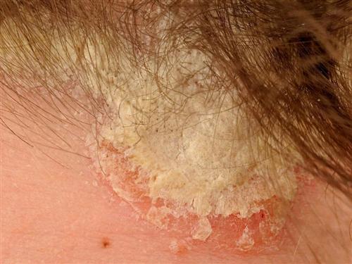牛皮癣变好的症状是什么