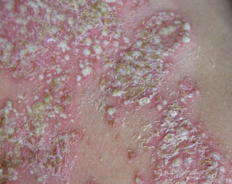 夏季如何做好防治避免牛皮癣复发