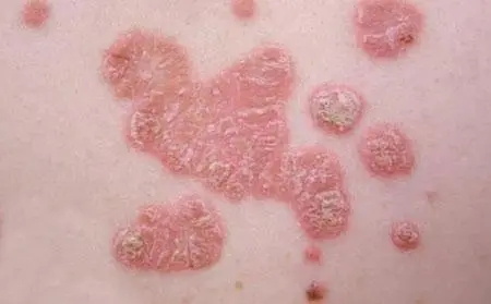 牛皮癣患者能否使用精油