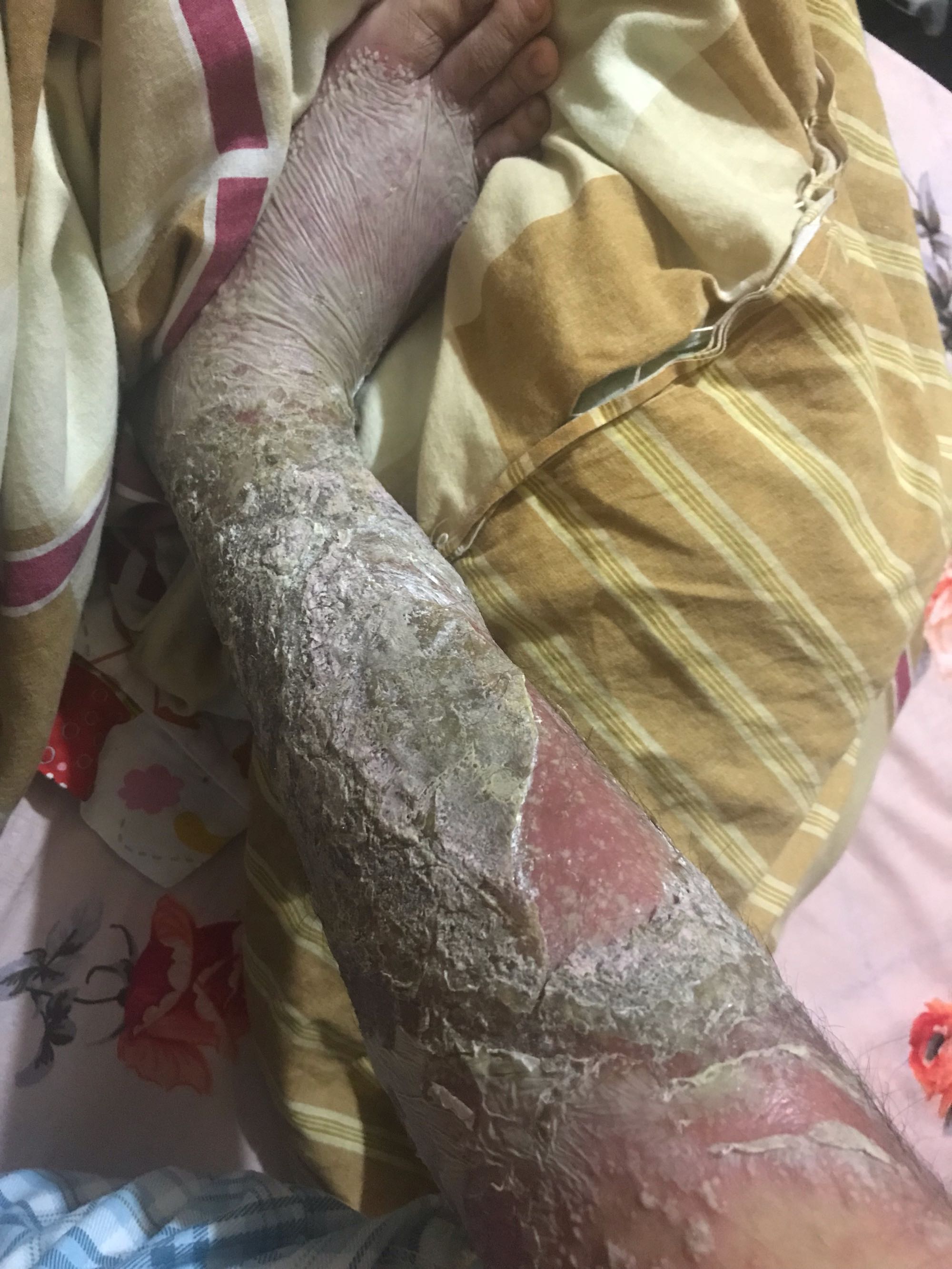 春季感冒频发-牛皮癣患者小心感染引起不适