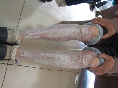 牛皮癣患者如果常吃早饭可以让疾病恢复吗