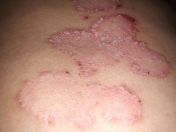 什么方法才能将牛皮癣这个大恶魔赶走