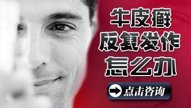 哪些人群易得牛皮癣