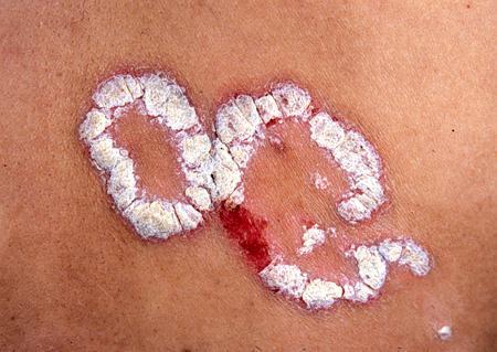 广州治疗银屑病地址在哪,广州银屑病专科