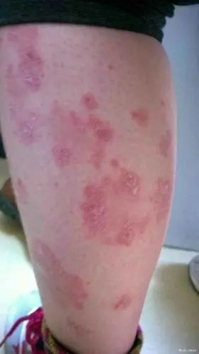 牛皮癣患者能否养宠物