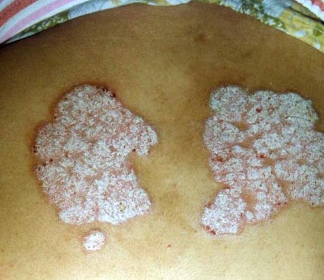 得了牛皮癣广州医生教你如何做保健