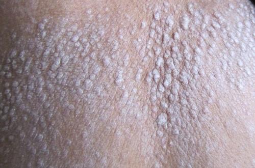 情绪波动大,银屑病不请自来