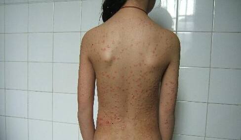 防护牛皮癣患者们需要怎么注意这个疾病呢